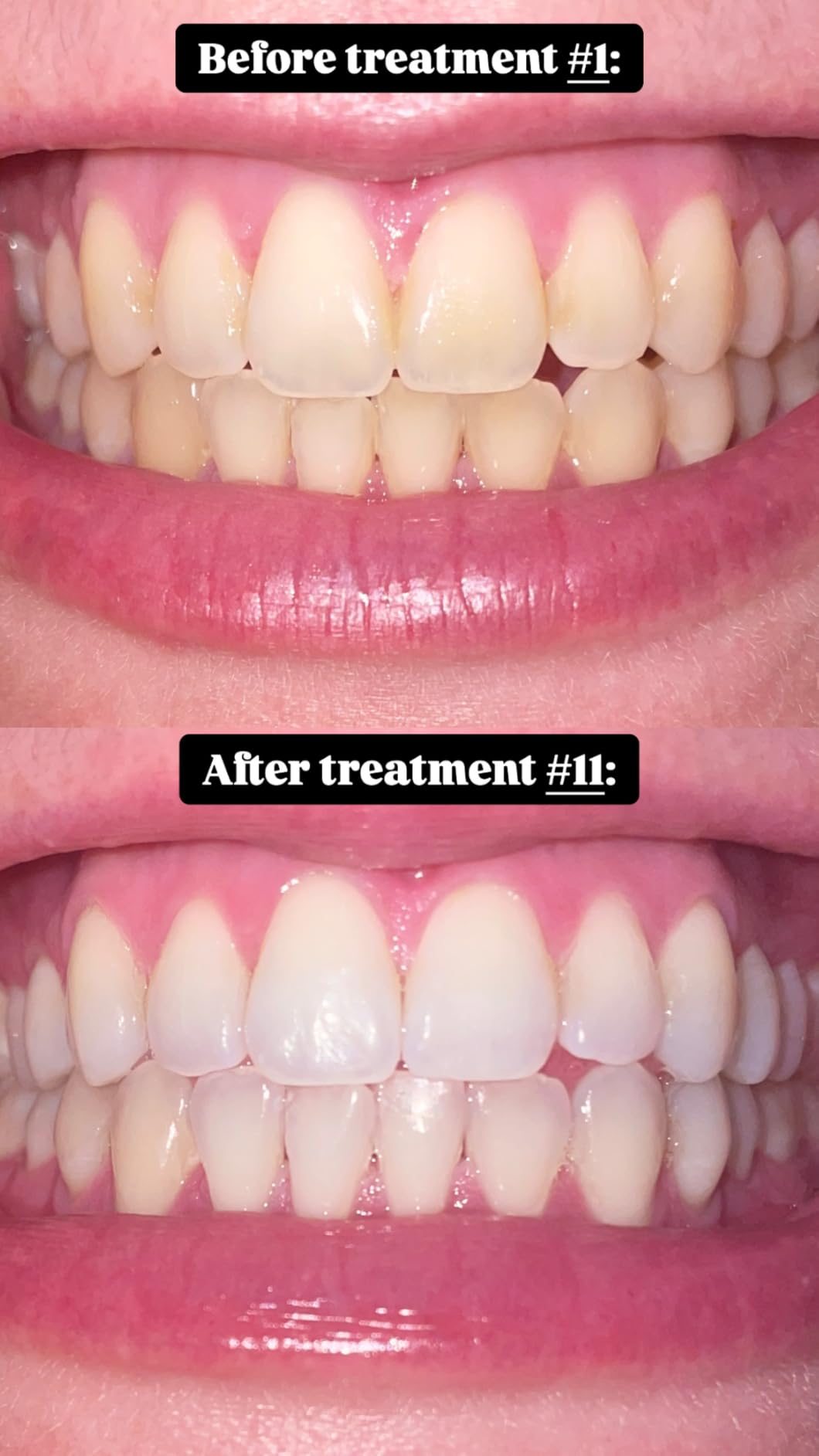Auraglow Teeth Whitening Kit, LED Accelerator Light, 35% Carbamide Peroxide Teeth Whitening Gel, 20+ Whitening Treatments, Whitens up to 10 Shades in 7 Days customer photo 2