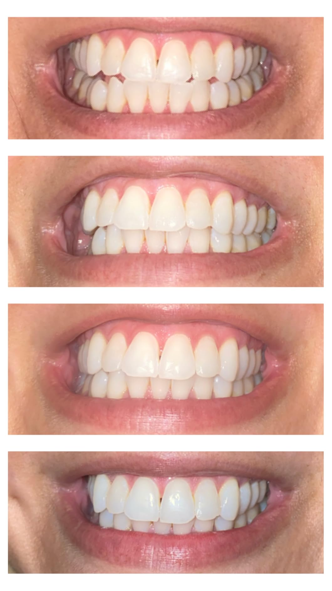 iSmile Teeth Whitening Kit - LED Light, 35% Carbamide Peroxide, (3) 3ml Gel Syringes, (1) Remineralization Gel, and Tray customer photo 2
